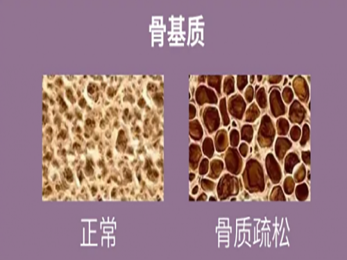 预防骨质疏松，温莎之谜鱼胶原蛋白肽对骨骼有强健作用