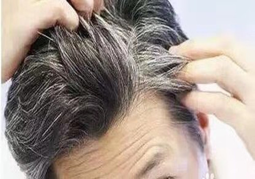 长白发是什??原因造成???