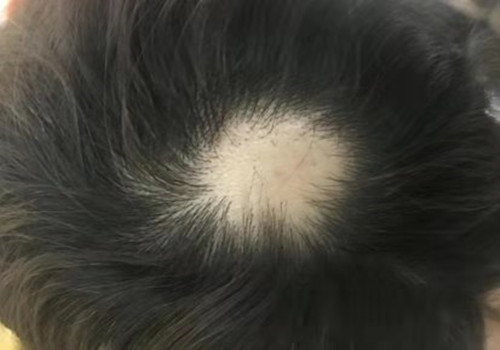头顶秃?€么办