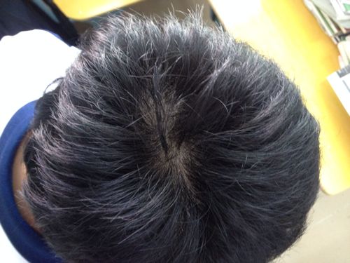 脂溢性毛囊炎症状