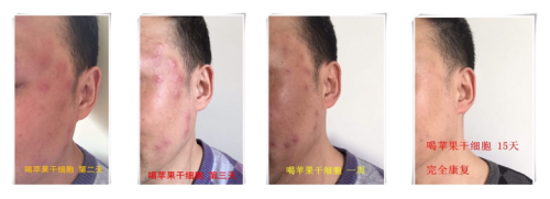 维萃美苹果干细胞固体饮品，排出毒素，还你好皮肤.png