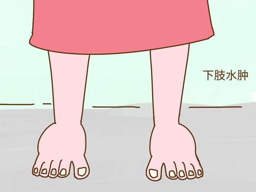 下肢水肿的原因