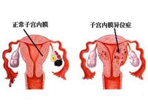 子宫内膜异位症的症状