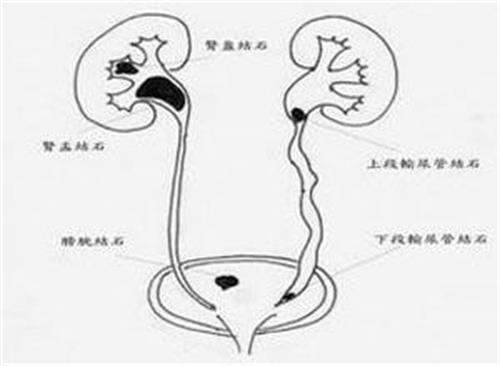泌尿系统感染的原???