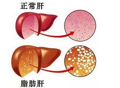肝病有些什??症状