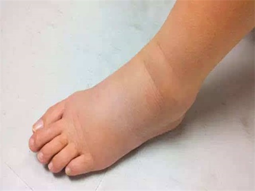 腿水肿吃什??消肿最??