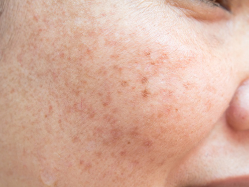 怎样能快速祛斑