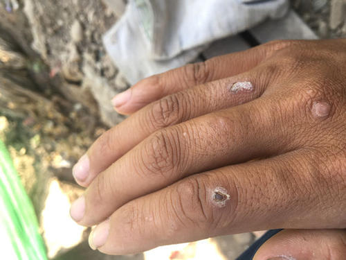 寻常疣原因引起的