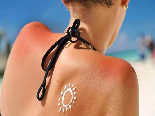 皮肤晒伤发红怎么???