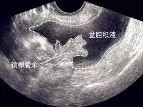 宫腔积液是?€么回???