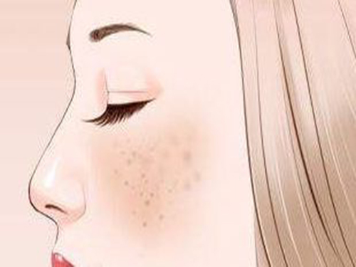 色斑如何去除