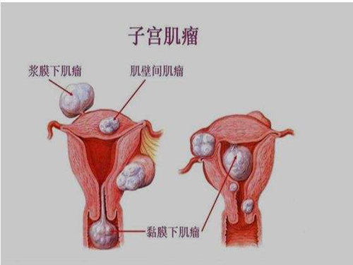 子宮肌瘤吃什么能消除