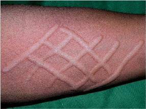 过敏性荨麻疹能自愈吗