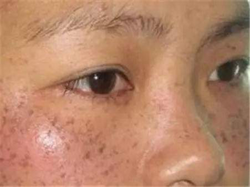 黄褐斑的原因