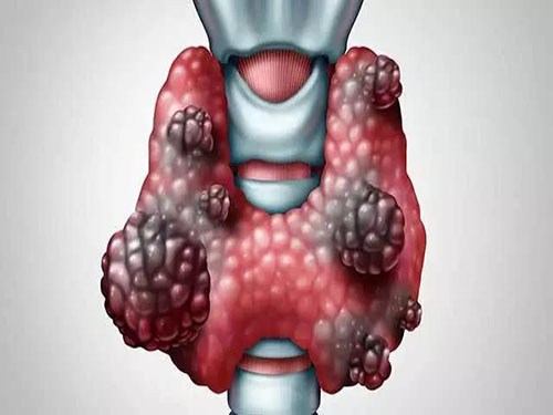 甲状腺肿瘤症???