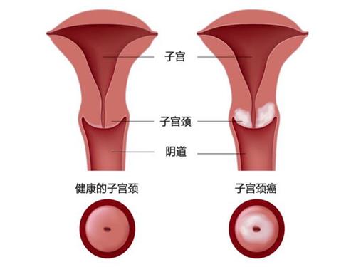 宫颈病变有什么症???