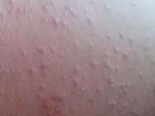 麻疹怎么预防
