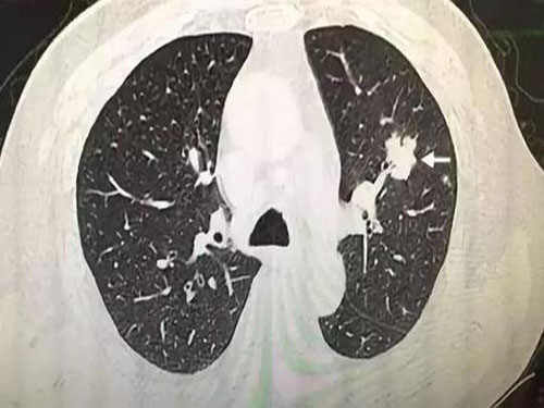 Pulmonary nodule