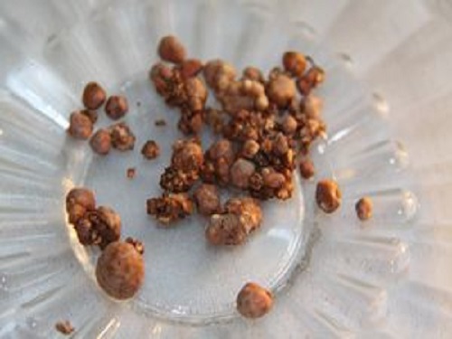 胆结石有什??症状