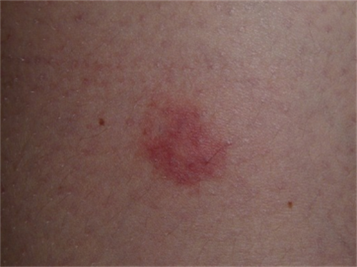 神经性皮炎怎么除根