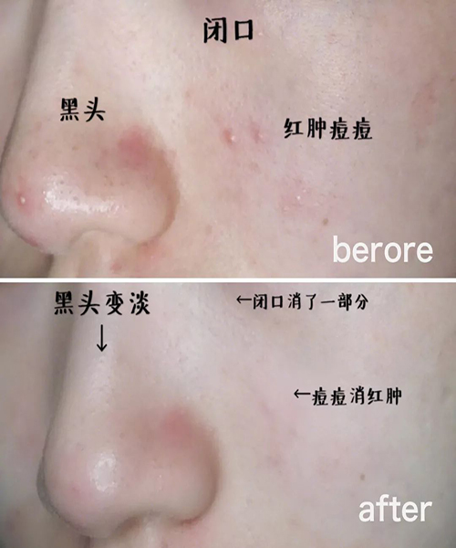 神奇的高活?€冻干技??助你重塑肌肤—?€温莎之谜试管面膜